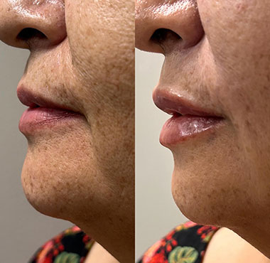 Lip-Filler