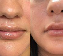 Lip-Filler