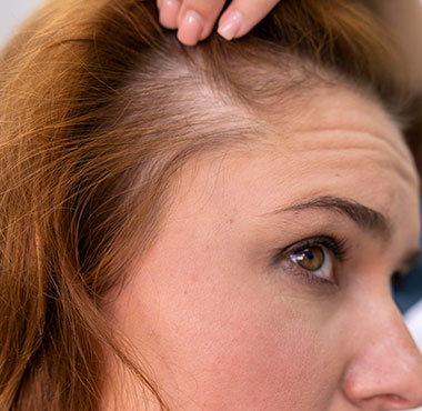 PRF-Hair-Restoration2